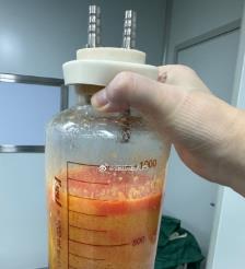 清远水动力吸脂手术要做多久？